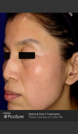 After Photo for Wrinkle Reduction with PicoSure -  - Prejuvenation