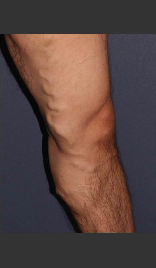 Before Photo for Non-surgical Leg Vein Treatment - Mitchel P. Goldman M.D. - Prejuvenation