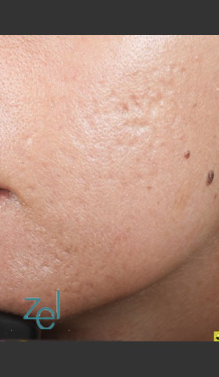 After Photo for Fractional Resurfacing Acne Scars - Brian D. Zelickson, M.D. - Prejuvenation