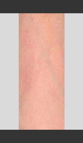 After Photo for Gentle Laser Vascular Lesions Treatment -  - Prejuvenation