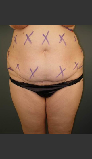 Before Photo for Liposuction #44 Front View - Dr. David Amron - Prejuvenation