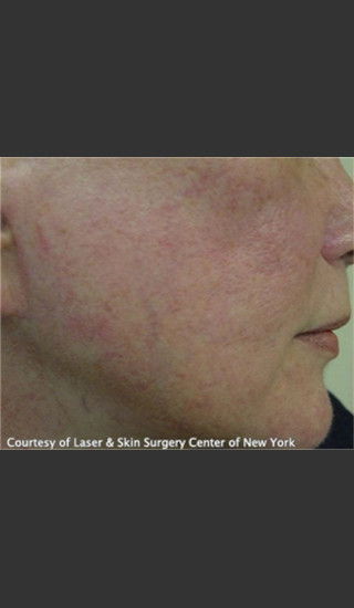 Before Photo for Treatment of Facial Blood Vessels -  - Prejuvenation