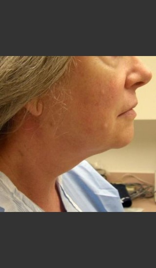 Before Photo for Dr. Langdon Precision TX  - Robert Langdon - Prejuvenation