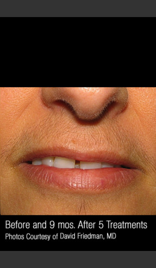 Before Photo for Hair Removal #312 -  - Prejuvenation