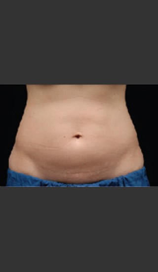 Before Photo for Dr. Langdon CoolSculpting - Robert Langdon - Prejuvenation