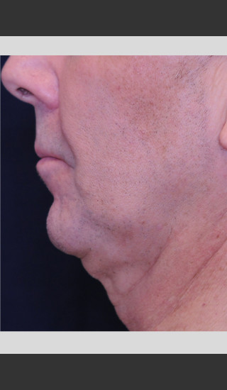 Before Photo for Profound Contour Treatment of Neck -  - Prejuvenation