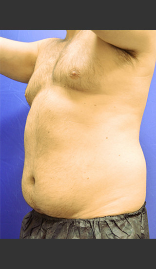 Before Photo for Liposuction Case #1 - Paul C. Dillon, MD - Prejuvenation