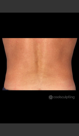 After Photo for CoolSculpting Before & After on Man -  - Prejuvenation