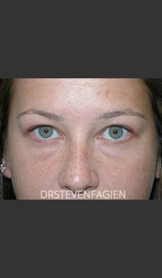 Before Photo for Lower Eyelid Fat Removal - Patient 4 - Steven Fagien, MD - Prejuvenation