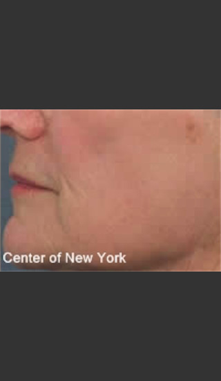 After Photo for Treatment of Fine lines and Wrinkles -  - Prejuvenation
