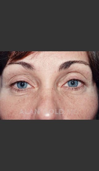 Before Photo for Blepharoplasty 1014 - Alan Gold MD - Prejuvenation