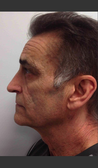 Before Photo for Infini Rhytides Treatment #21 -  - Prejuvenation