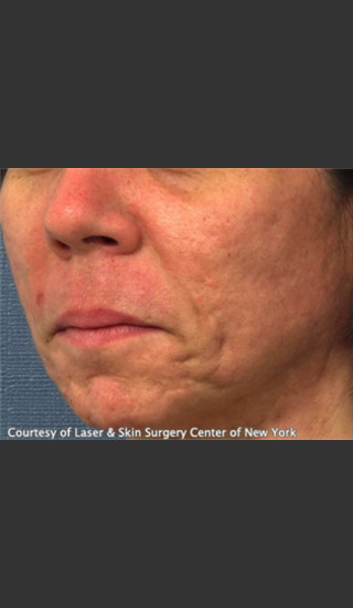 Before Photo for Treatment of Facial  Acne Scars -  - Prejuvenation