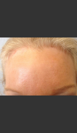 After Photo for Before & After Botox - Janell Ocampo - Prejuvenation