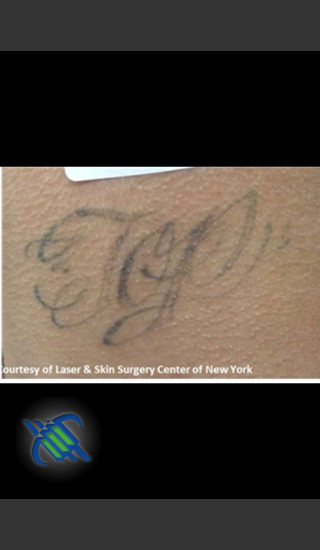 Before Photo for Treatment of Lower Back Tattoo - Roy G. Geronemus, M.D. - Prejuvenation