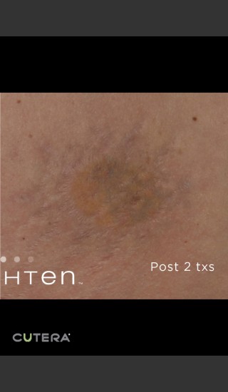 After Photo for Tattoo Removal Before & After Photo of Sun -  - Prejuvenation