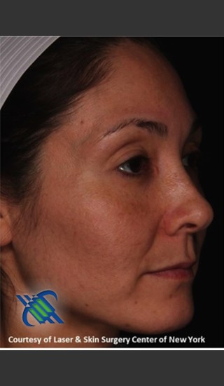 After Photo for Facial Skin Rejuvenation of Face - Roy G. Geronemus, M.D. - Prejuvenation