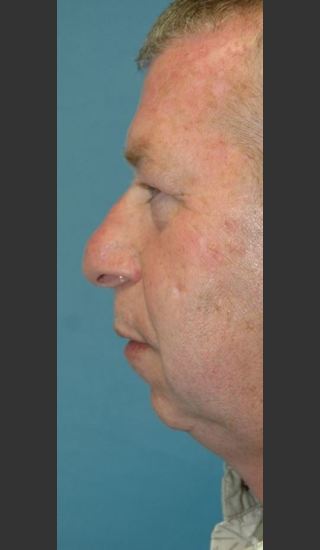 Before Photo for Rhinoplasty Male Patient - Timothy Miller - Prejuvenation