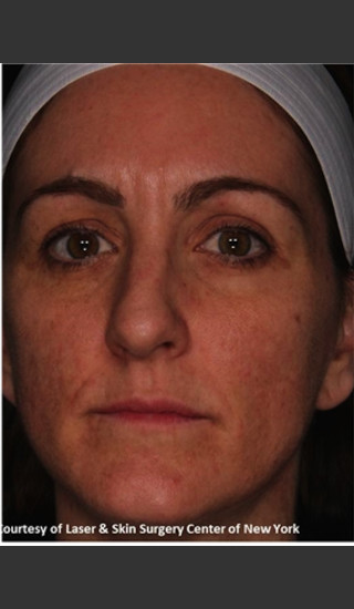 After Photo for Full face Treament with Fraxel - Roy G. Geronemus, M.D. - Prejuvenation