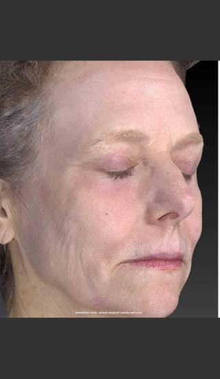 After Photo for Wrinkle and Brown Spot Reduction - Douglas Wu, M.D. - Prejuvenation