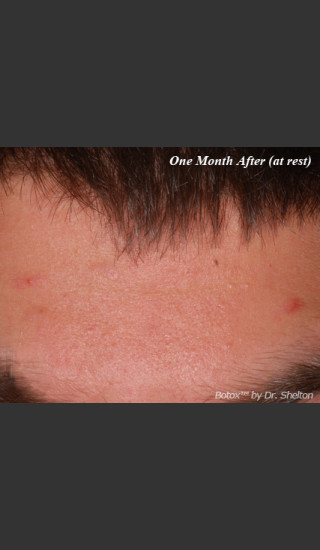 After Photo for Treatment of Forehead Creases with Botox - Ron M. Shelton, M.D. - Prejuvenation