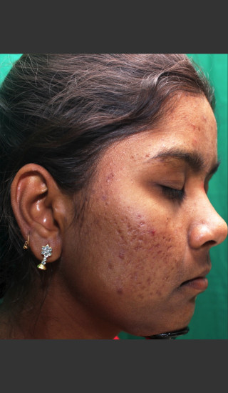 Before Photo for Infini Rhytides Treatment #22 -  - Prejuvenation