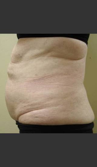 After Photo for Vanquish NonInvasive Body Shaping - James Newman - Prejuvenation