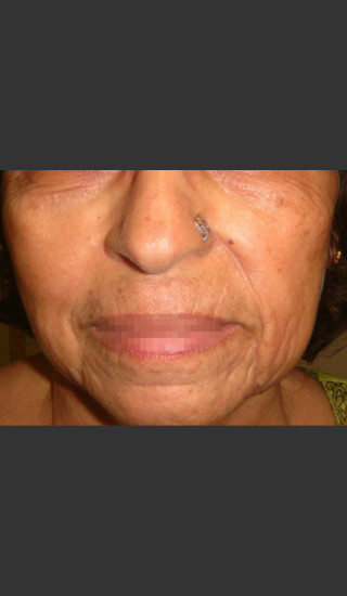 Before Photo for Infini Rhytides Treatment #20 -  - Prejuvenation