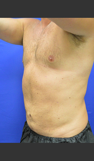 After Photo for Liposuction Case #1 - Paul C. Dillon, MD - Prejuvenation
