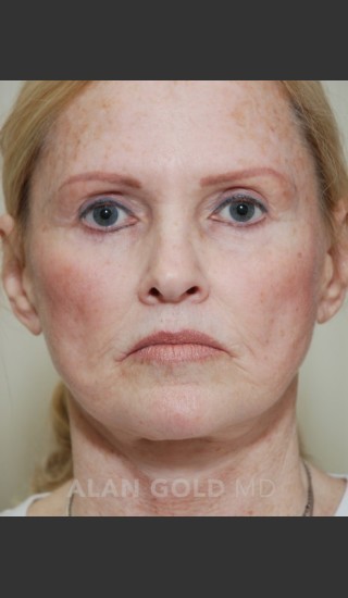 Before Photo for Rhytidectomy (Facelift) 1753 - Alan Gold MD - Prejuvenation