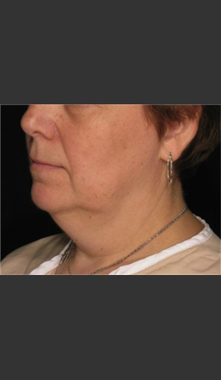 Before Photo for Treatment of Neck with Laser Liposuction -  - Prejuvenation
