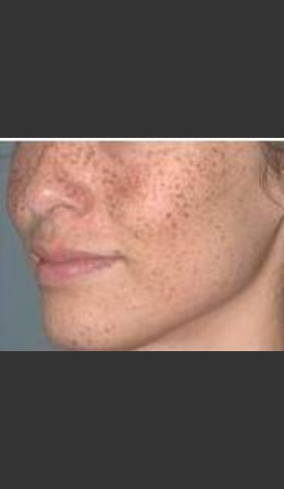 Before Photo for Lumecca Intense Pulsed Light  #1 -  - Prejuvenation