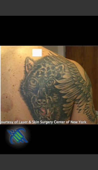 Before Photo for Treatment of Shoulder Tattoo - Roy G. Geronemus, M.D. - Prejuvenation