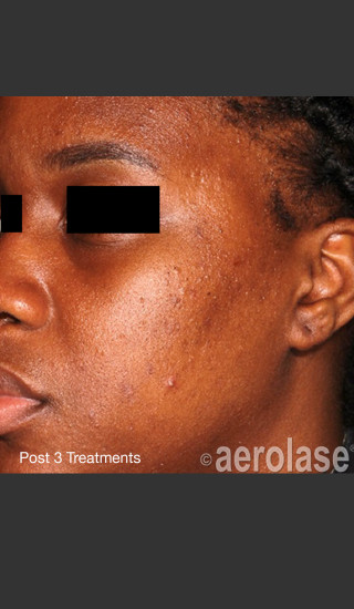 After Photo for NeoClear by Aerolase Acne Treatment -  - Prejuvenation