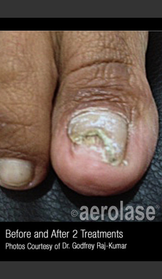 Before Photo for Treatment of Nail Fungus #321 -  - Prejuvenation