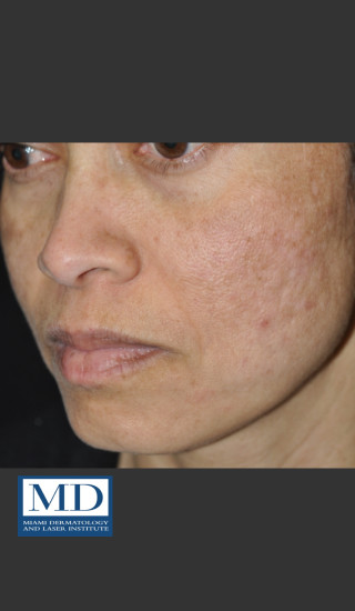 After Photo for Melasma Face Treatment 117 - Jill S. Waibel, MD - Prejuvenation
