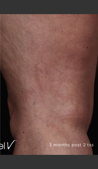 After Photo for Back of Thigh Leg Vein Clearance  -  - Prejuvenation