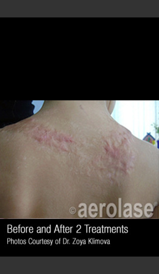 Before Photo for Treatment of a Juvenile Burn Scar #343 -  - Prejuvenation