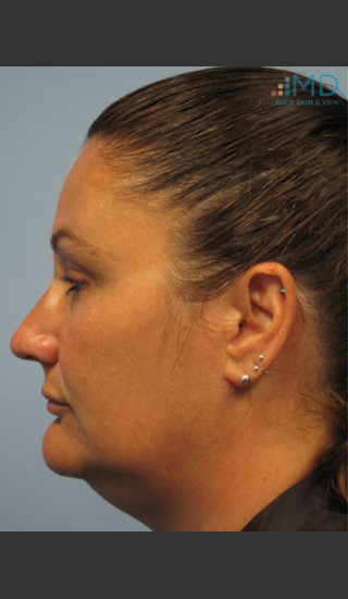 Before Photo for Exilis Skin Tightening of the Lower Face - Margaret Ann Weiss - Prejuvenation