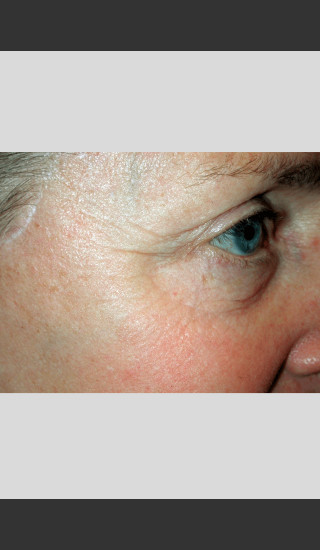 After Photo for Vbeam Pulsed Dye Laser - Wrinkles -  - Prejuvenation