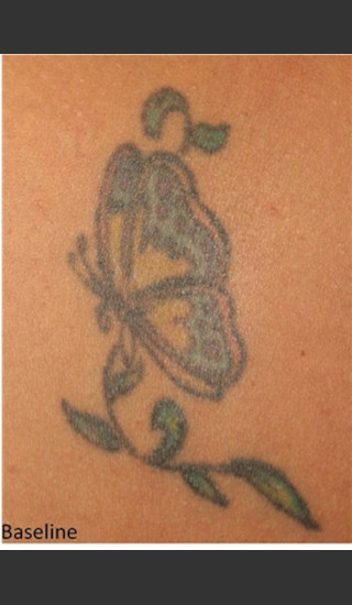 Before Photo for Treatment of Tattoo -  - Prejuvenation