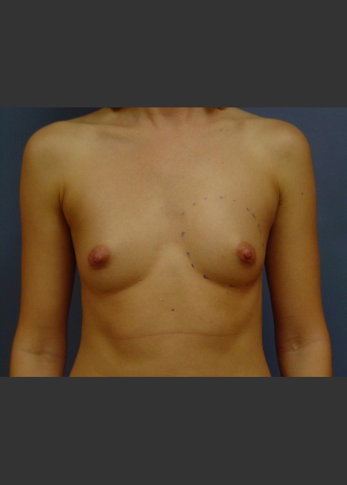 Before Photo for Breast Augmentation - Michael S. Beckenstein, MD - ZALEA Featured Before & After