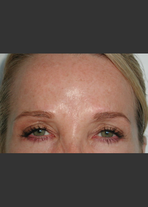 After Photo for Serene Procedure (Nuebelle) - James Newman  - ZALEA Featured Before & After