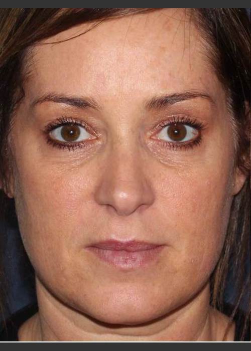 Before Photo for Lip Augmentation - Douglas Wu, M.D. - ZALEA Featured Before & After