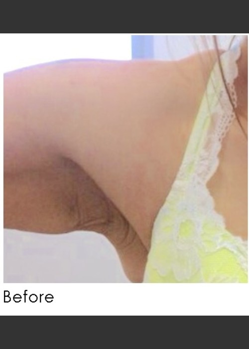 Before Photo for Sculptra for Arm Laxity  - Annie Chiu, MD - ZALEA Featured Before & After