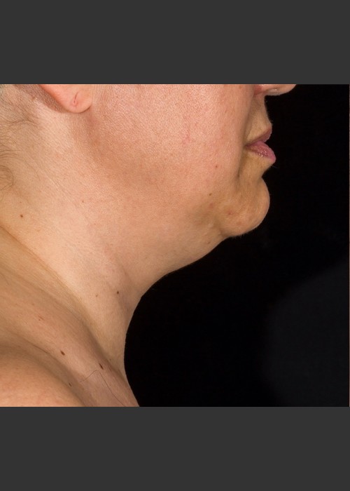 Before Photo for SculpSure Submental - Bruce E Katz, M.D. - ZALEA Featured Before & After