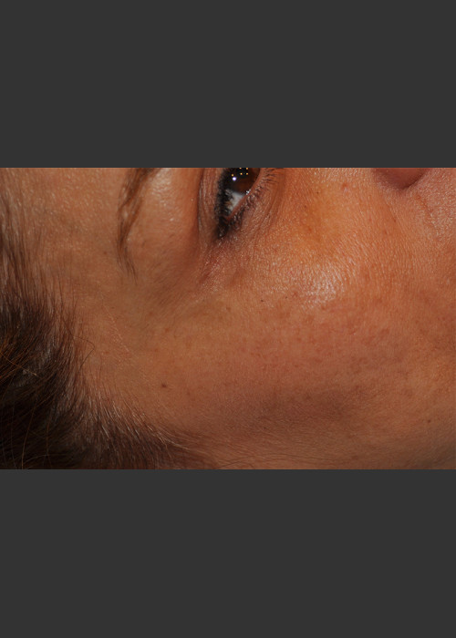 After Photo for Dr. Palmer Vein Removal 01 - Shane Palmer  - ZALEA Featured Before & After