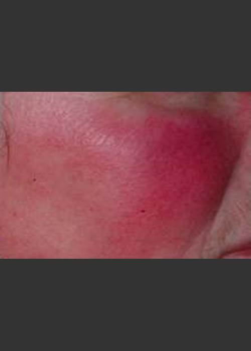 Before Photo for IPL Treatment #19 - Harvey H. Jay, M.D. - ZALEA Featured Before & After