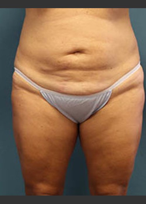 Before Photo for Before and After Tummy Tuck - Arthur Handal - ZALEA Featured Before & After