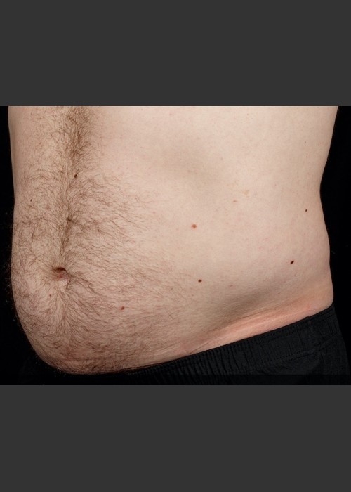 Before Photo for SculpSure Abdomen - Sean Doherty - ZALEA Featured Before & After